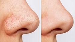 Skin Care: બ્લેકહેડ્સને 10 મિનિટમાં દુર કરશે આ ઘરગથ્થુ ઉપાય, ટ્રાય કરો કોઈ એક ઉપાય