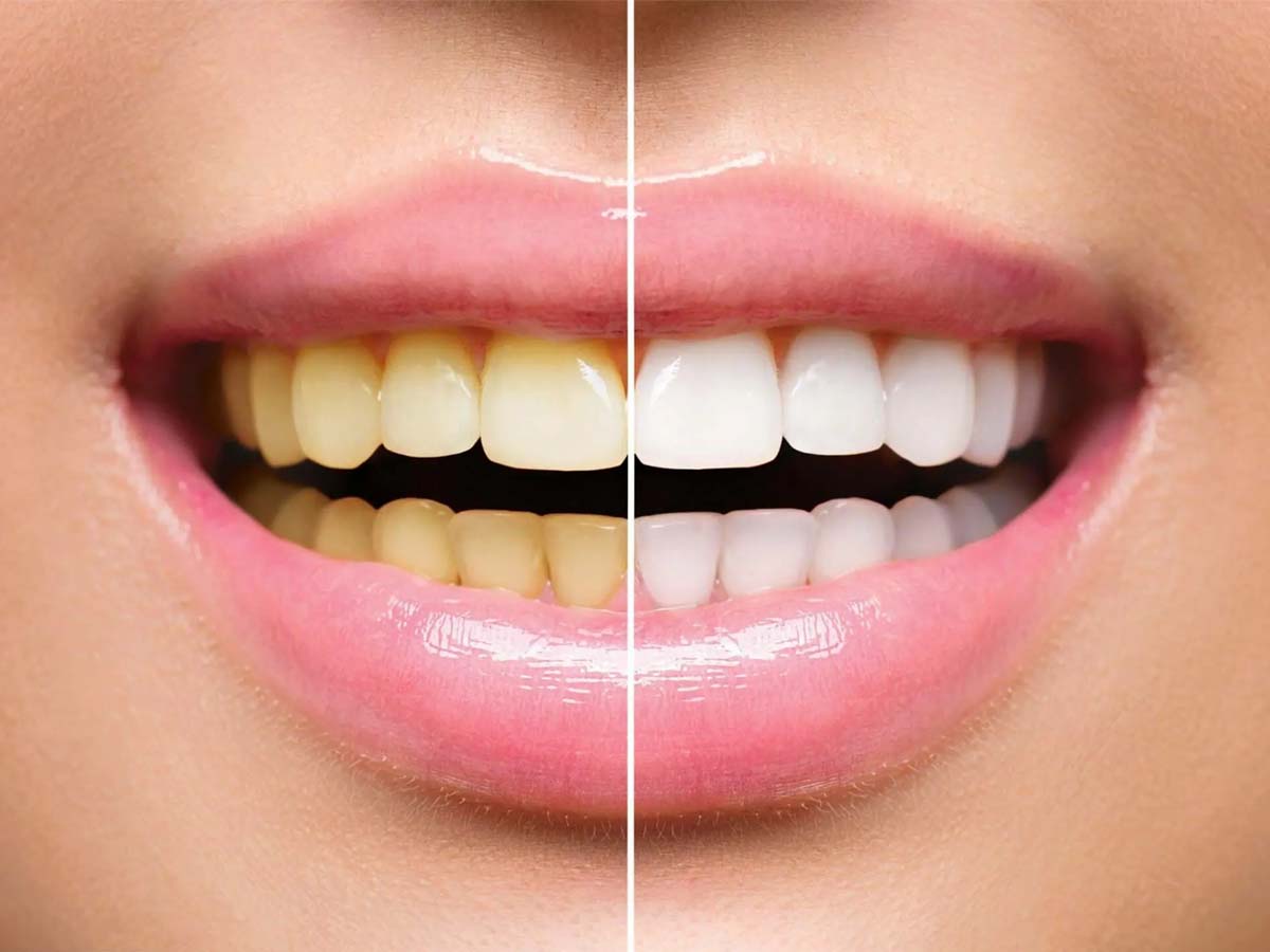 Teeth Whitening