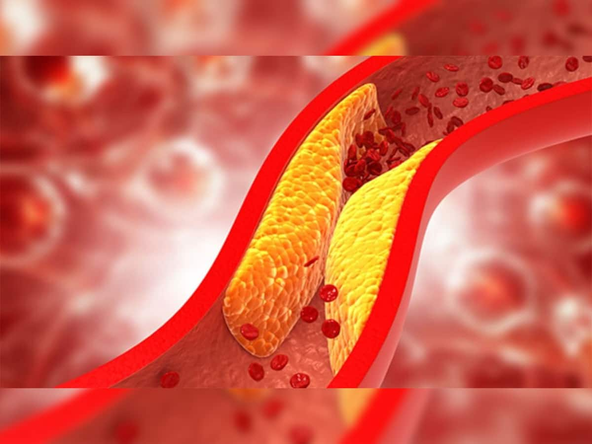 Bad Cholesterol: વધેલુ બેડ કોલેસ્ટ્રોલ કંટ્રોલ કરી છે આ 5 ફળ, આજથી જ રોજ ખાવાની કરો શરુઆત, થશે લાભ