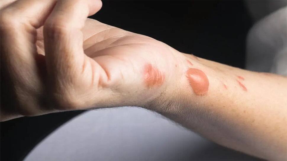 how-to-get-rid-of-burn-marks-natural-way-to-remove-burn-marks-home