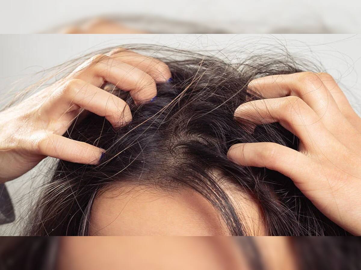 Itchy Scalp: માથામાં આવતી ખંજવાળથી પરેશાન છો ? આ સરળ ઉપાય તમારી સમસ્યા એકવારમાં કરશે દુર