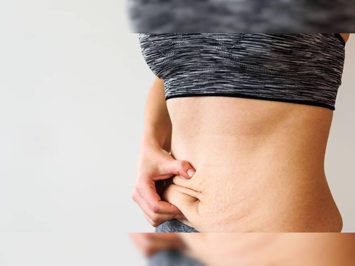 Belly Fat દુર કરવા અપનાવો આ સરળ ઉપાય, 15 દિવસમાં ફેટમાંથી ફીટ થઈ જશો