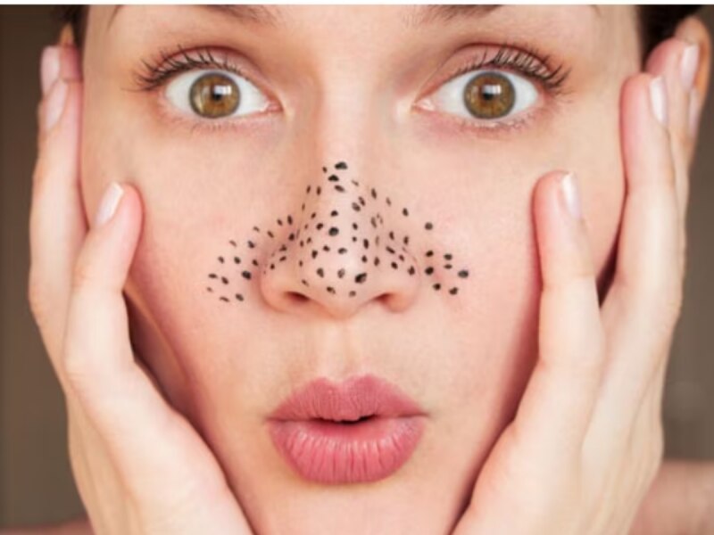 Blackheads Home Remedies: ચહેરા પર જામેલા બ્લેક હેડ્સ દૂર કરવા અજમાવો આ ઘરેલુ નુસખા