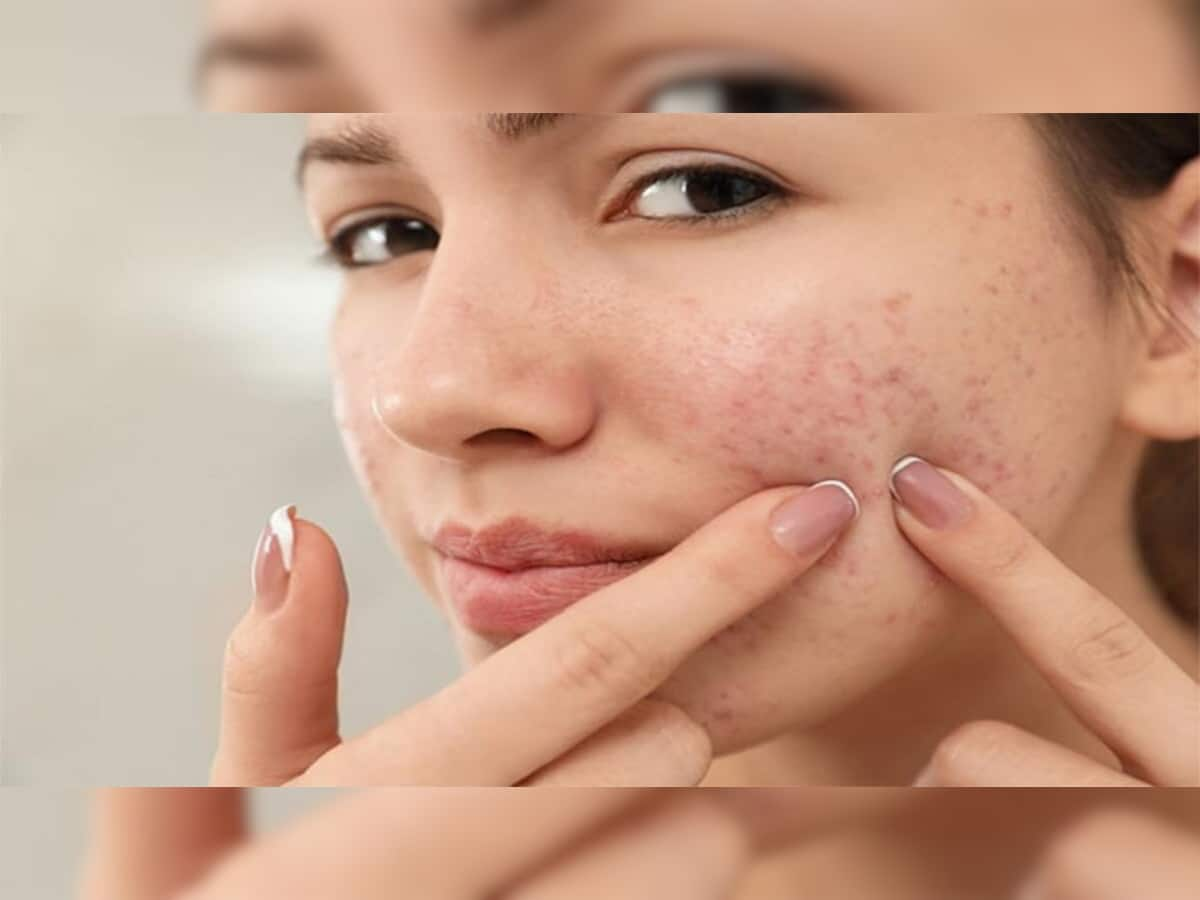 Skin Care: ખીલને દૂર કરવા ટ્રાય કરો આ પાંચમાંથી કોઈ એક ઉપાય, એક વીકમાં ખીલ અને ડાઘ બંને હશે ગાયબ