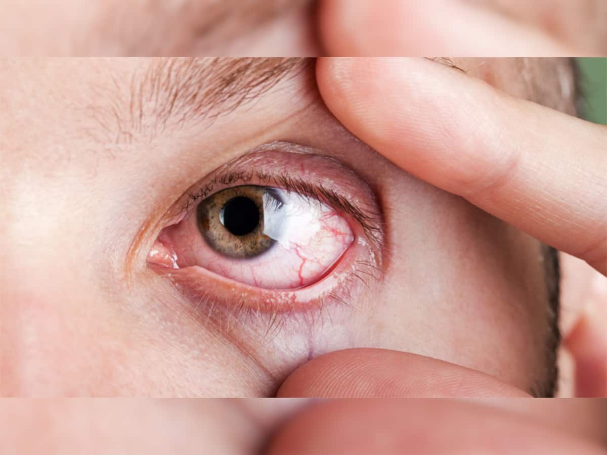 Dry Eye: શિયાળામાં વધી જાય છે આંખમાં ડ્રાયનેસ, આ રીતે રાખશો ધ્યાન તો નહીં વધે તકલીફ