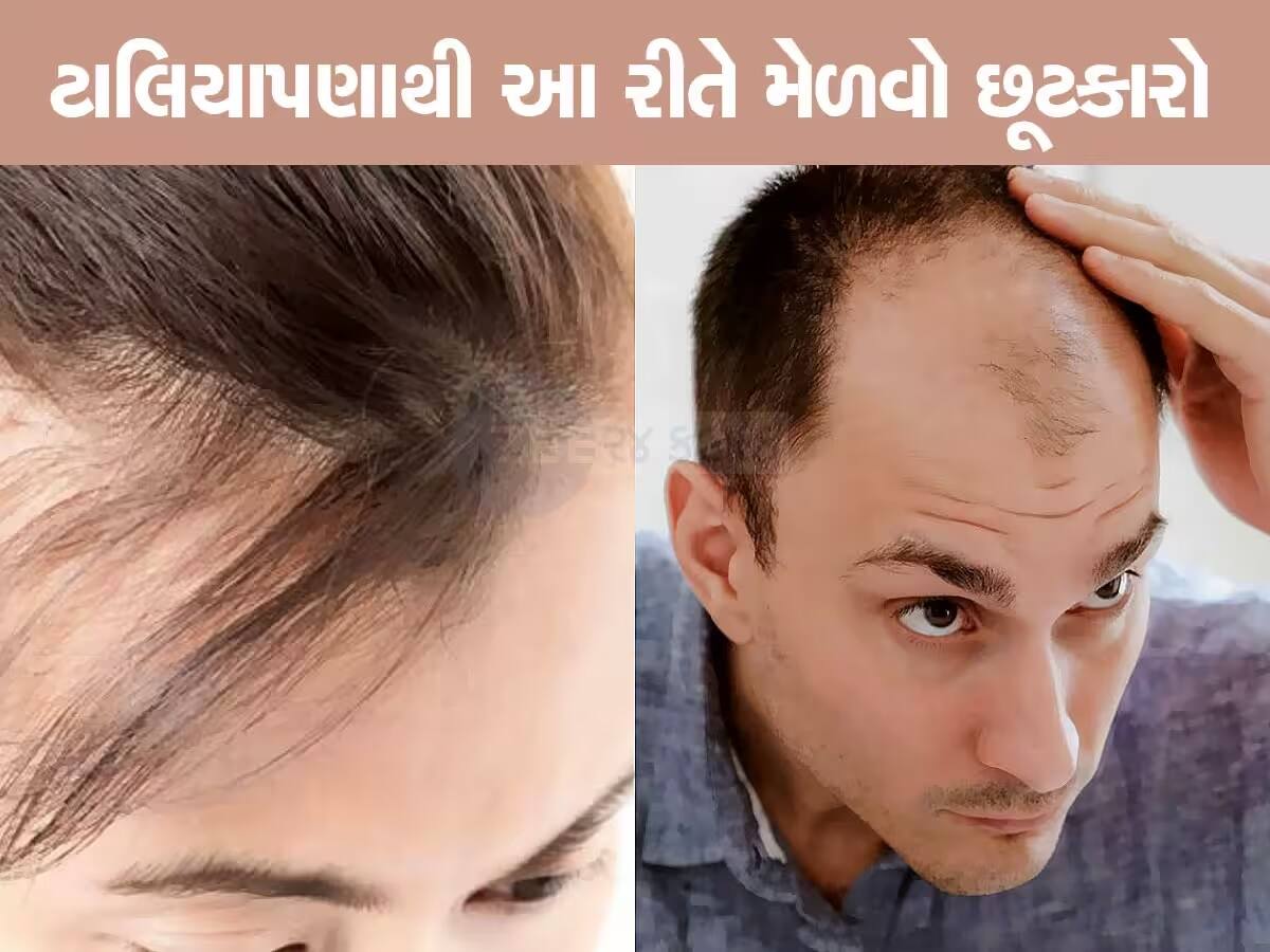 'ટાલિયા અંકલ' : ગુજરાતીઓએ આ મહેંણું ના સાંભળવું હોય તો કરો આ ઉપાય, અટકી જશે ખરતા વાળ