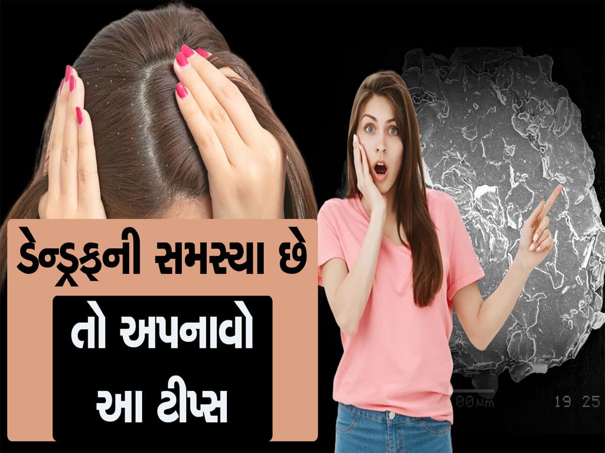 How To Remove Dandruff : આ 3 ઘરેલુ નુસ્ખાથી વાળમાંથી ગાયબ થઈ જશે ડેન્ડ્રફ 