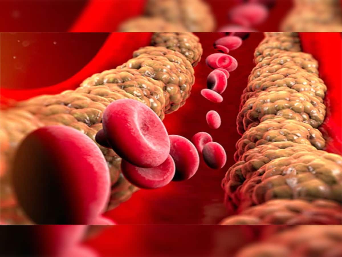 Bad Cholesterol: બેડ કોલેસ્ટ્રોલને ઝડપથી ઘટાડે છે આ વસ્તુઓ, આજથી જ અપનાવો આ જાદુઈ ઉપાય