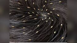 Hair Care: ધીરે ધીરે માથાના વાળ જવા લાગ્યા પણ આ જૂ નથી જતી? કરો આ ઉપાય