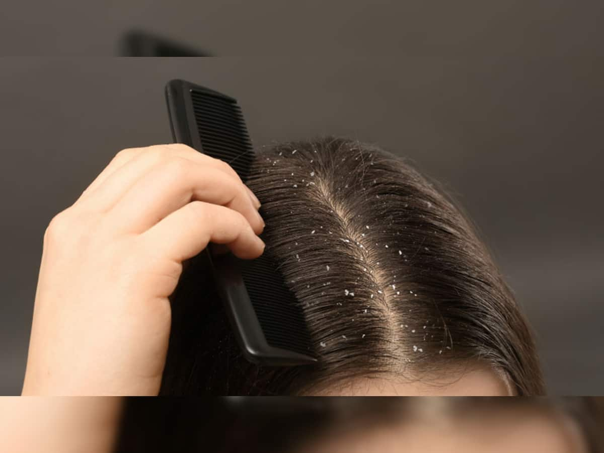 Dandruff: 7 દિવસમાં ડેન્ડ્રફ થઈ જશે સાફ, વાળને સુંદર અને ડેન્ડ્રફ ફ્રી બનાવશે આ ઘરેલુ નુસખા