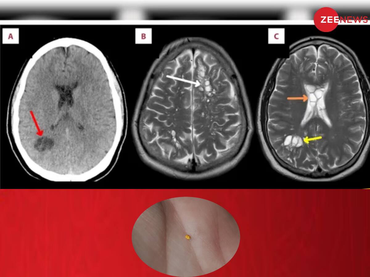 વિચિત્ર મેડિકલ કંડીશન: માણસના મગજમાંથી ટેપવર્મના ઇંડા, માઇગ્રેનની થતી હતી ફરિયાદ