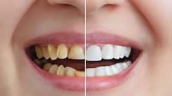 Yellow Teeth: માત્ર 5 રુપિયાના ખર્ચે પીળા દાંત થઈ જશે મોતી જેવા સફેદ, અજમાવો એકવાર