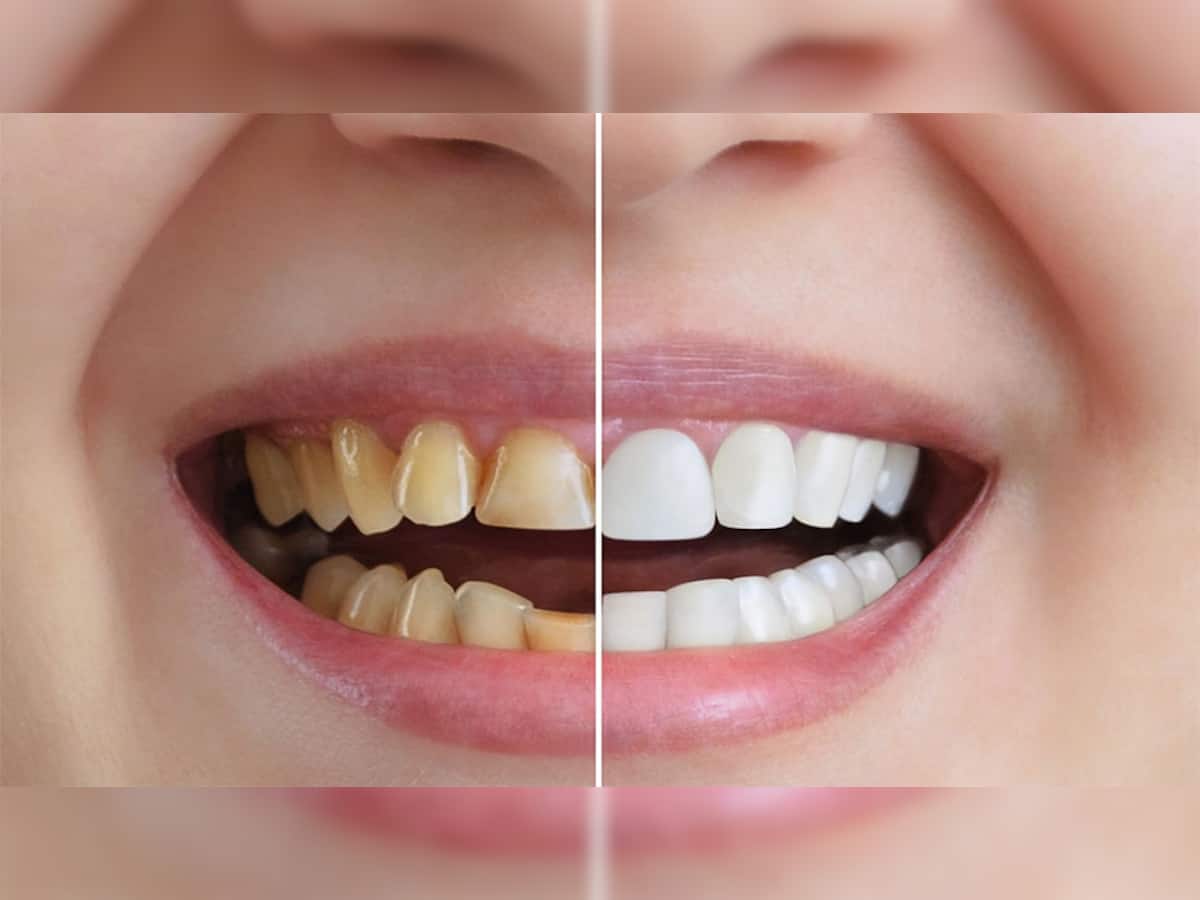 Yellow Teeth: માત્ર 5 રુપિયાના ખર્ચે પીળા પડેલા દાંત થઈ જશે મોતી જેવા સફેદ, ટ્રાય કરો એકવાર