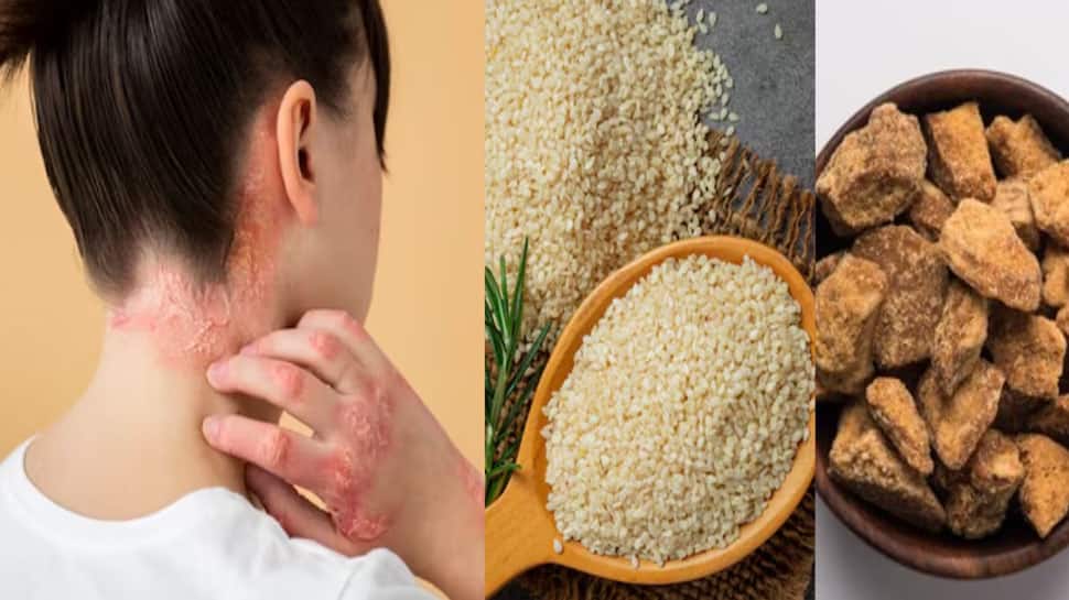 Skin Innoculation Infection Skin Infection: ધાધર, ખરજવું જેવા ત્વચાના રોગથી પરેશાન લોકોએ ન ખાવી આ 5 ...