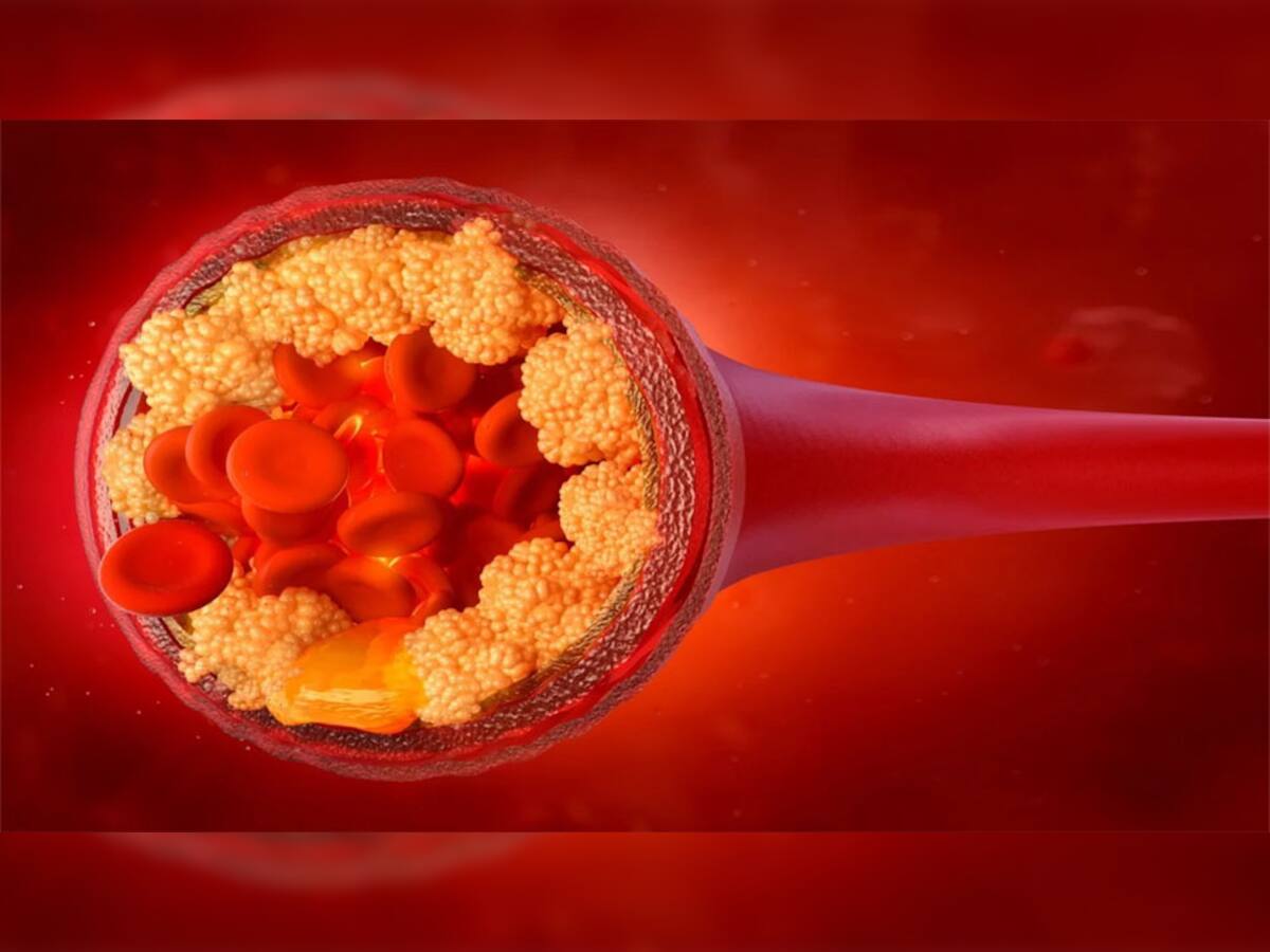Bad Cholesterol: શરીરમાં વધેલા બેડ કોલેસ્ટ્રોલને તુરંત કંટ્રોલ કરે છે આ 5 વસ્તુઓ, આજથી જ ડાયટમાં કરો સામેલ