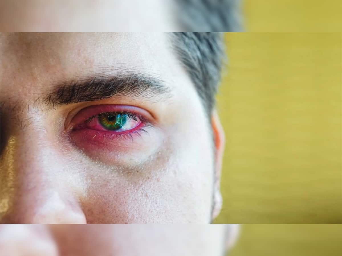 Eye Care: હીટવેવમાં આંખોની કાળજી નહીં રાખો તો થઈ જાશો હેરાન, આ રીતે રાખો આંખોનું ધ્યાન 