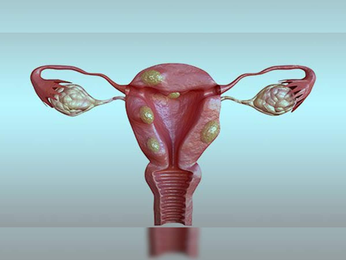 Fibroids: ગર્ભાશયમાં થઈ હોય ગાંઠ તો ખાવા લાગો આ ફળ, સંકોચાવા લાગશે ફાઈબ્રોઈડ જાતે જ