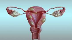 Fibroids: ગર્ભાશયમાં થઈ હોય ગાંઠ તો ખાવા લાગો આ ફળ, સંકોચાવા લાગશે ફાઈબ્રોઈડ જાતે જ