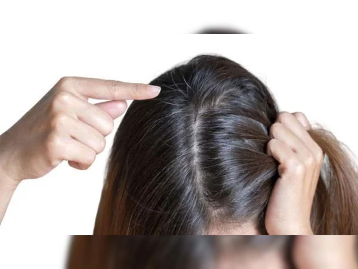 White Hair: આ કારણે ટીનએજમાં વાળ થવા લાગે છે સફેદ, જાણો સફેદ વાળનો ગ્રોથ અટકાવવાના દેશી ઉપાય