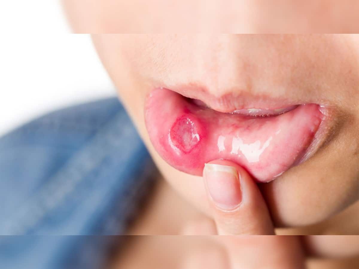 Signs of Oral Cancer: મોઢાના કેન્સરની શરુઆતમાં જોવા મળે આ 8 સંકેતો, 99 ટકા લોકો સામાન્ય સમજી કરે છે ઈગ્નોર