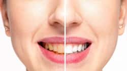 Yellow teeth: 1 ચમચી દહીં પીળા દાંતને કરી દેશે મોતી જેવા સફેદ, જાણો ઉપયોગ કરવાની રીત