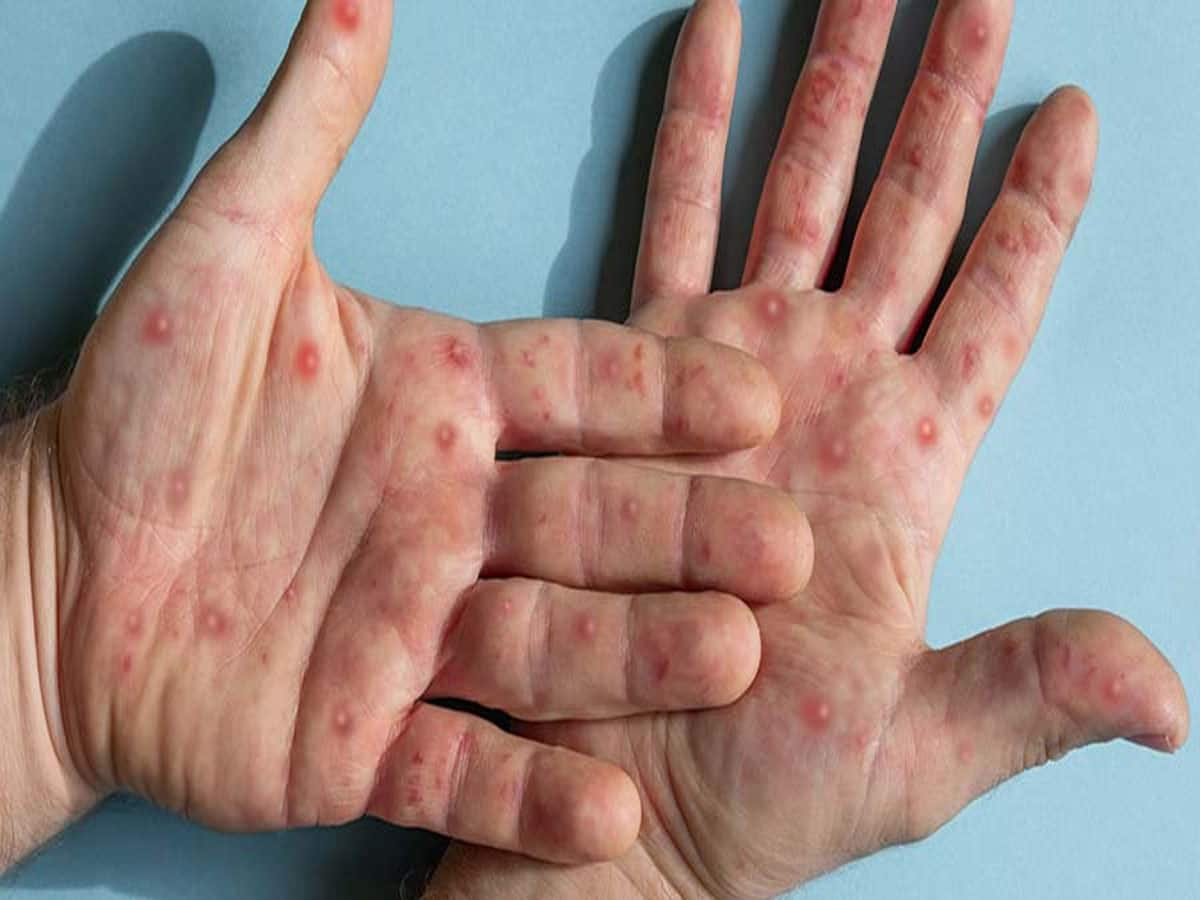 Mpox Outbreak: મંકીપોક્સનો વધ્યો પ્રકોપ, જાણો કેવી રીતે ફેલાય છે આ વાયરસ અને કેવા હોય તેના શરુઆતી લક્ષણ 