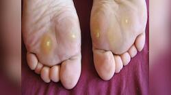 Diabetes: ડાયાબિટીસનો સંકેત હોય છે પગમાં થતી આ સમસ્યા, જાણો બચવા માટે શું કરવું ?