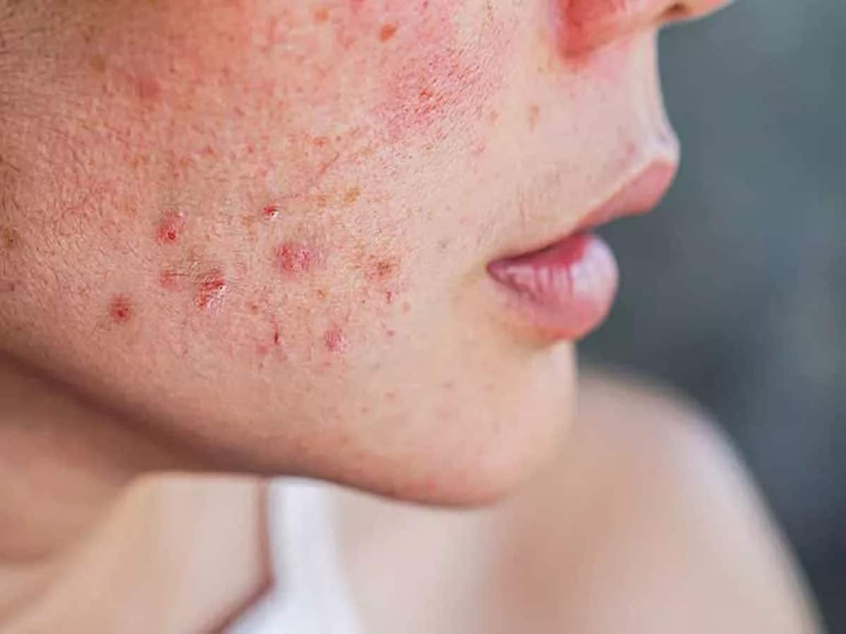 Period pimples: માસિકના 7 દિવસ પહેલા કરી લેશો આ કામ તો ત્વચા પર નહીં નીકળે હોર્મોનલ પિંપલ્સ