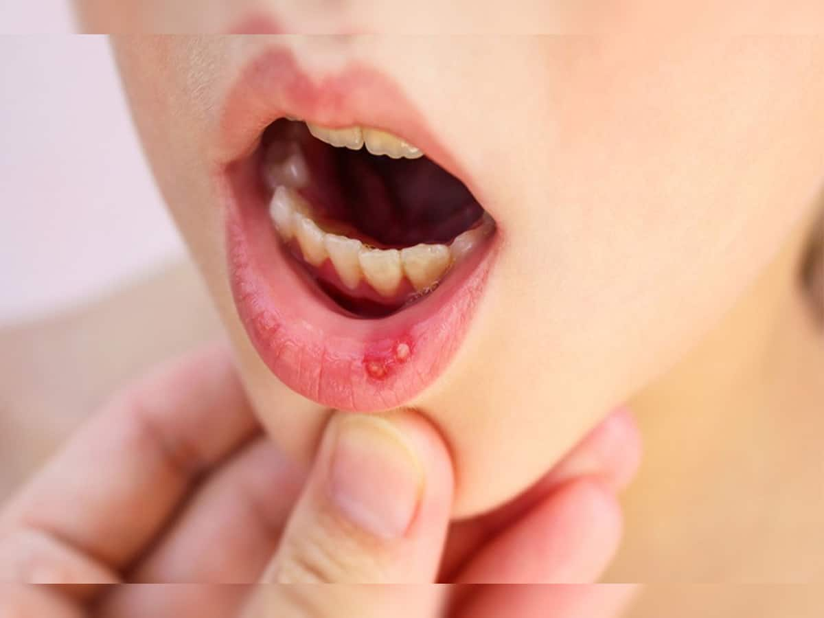 Mouth Ulcer: મોઢાના ચાંદાથી એક દિવસમાં મુક્તિ મેળવવી હોય તો ટ્રાય કરો આ 5 માંથી કોઈ 1 ઉપાય