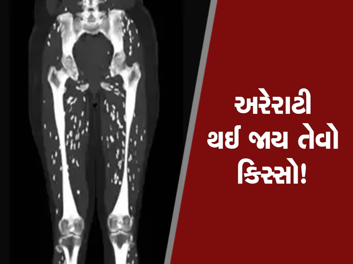 દર્દીના પગનું સિટી સ્કેન જોઈ ચોંકી ગયા ડોક્ટર્સ, પગમાં ફરતા દેખાયા જીવતા કીડા!