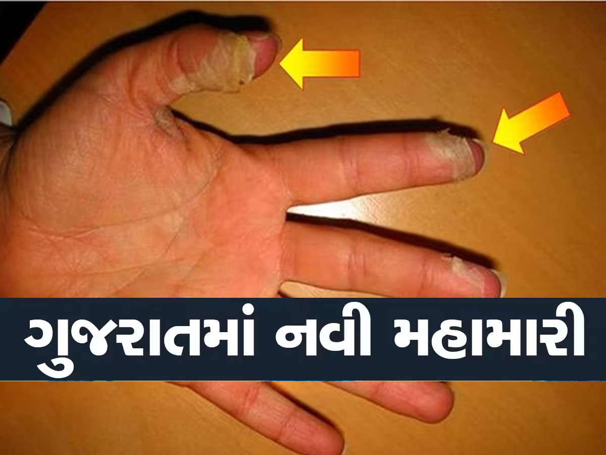 શરીરની ચામડી ઉતારી દે તેવા ભયાનક રોગની ગુજરાતમાં એન્ટ્રી, જુનાગઢમાં દેખાયો પહેલો કેસ