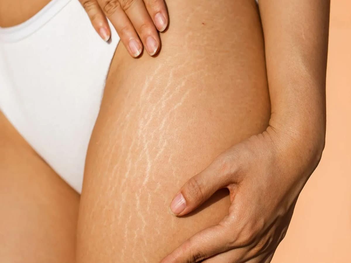 Stretch Marks: સાથળ પર લગાડો ઘરમાં રહેલી આ 4 વસ્તુમાંથી કોઈ 1, સ્ટ્રેચ માર્ક્સ 7 દિવસમાં ગાયબ થશે