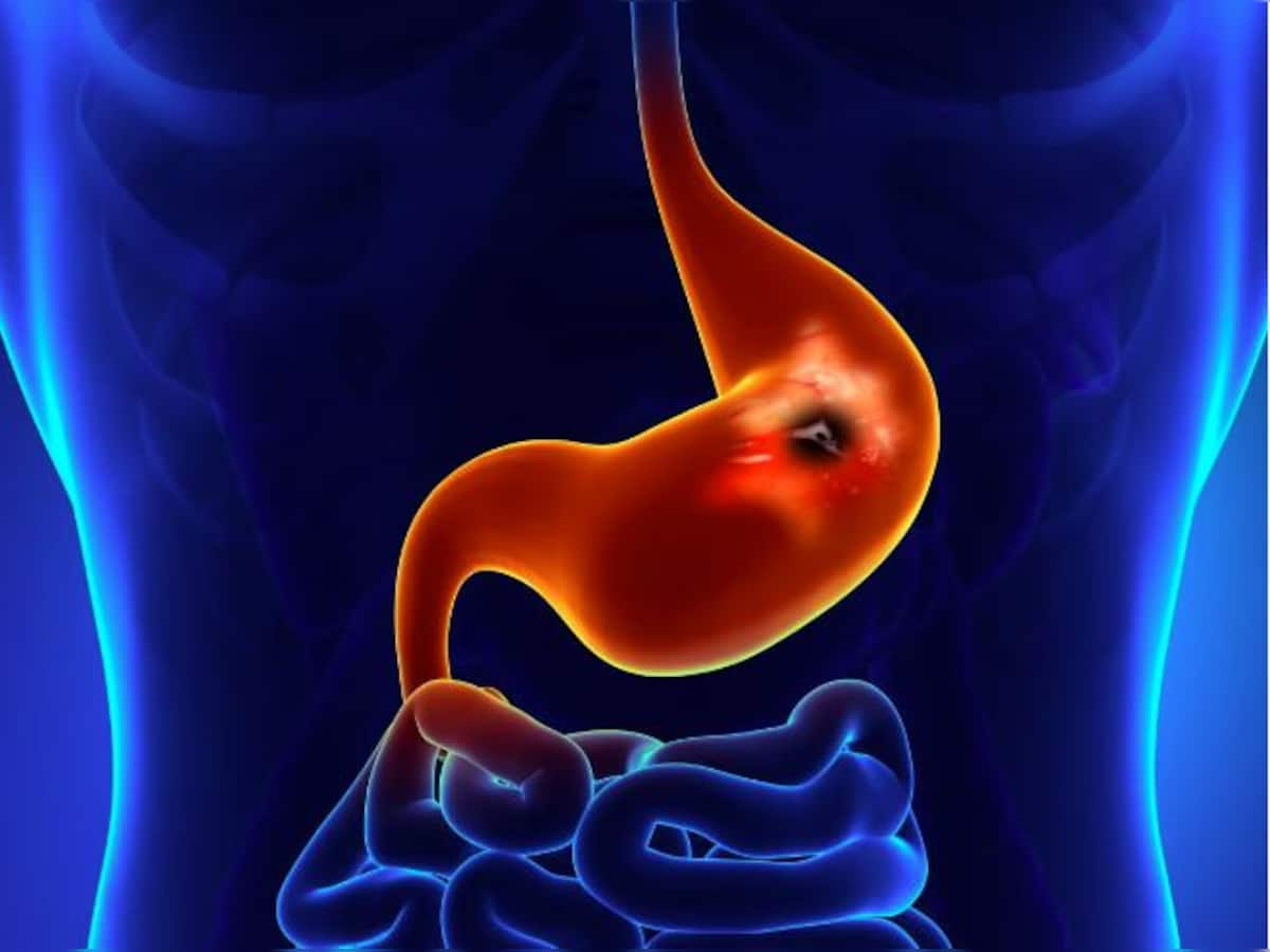 Stomach Ulcer: પેટમાં અલ્સરનું જોખમ વધારે શકે છે આ 5 ભૂલો, તમારા સ્વાસ્થ્યને થઈ શકે છે નુકસાન, તરત કરો સુધારો