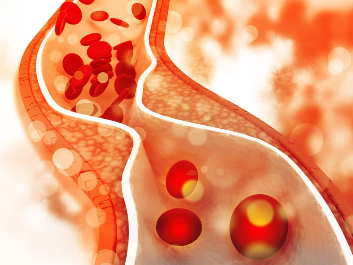 LDL Cholesterol: બેડ કોલેસ્ટ્રોલ ઘટાડવાના રામબાણ ઉપાય, ઘર પર કરો આ 5 વસ્તુ અને જુઓ કમાલ