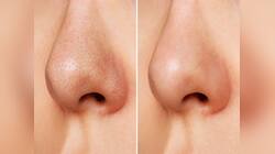 Blackheads: માત્ર 5 મિનિટમાં નાક પરના બ્લેકહેડ્સ થઈ જશે ગાયબ, અપનાવો આ ઘરેલુ ઉપાય