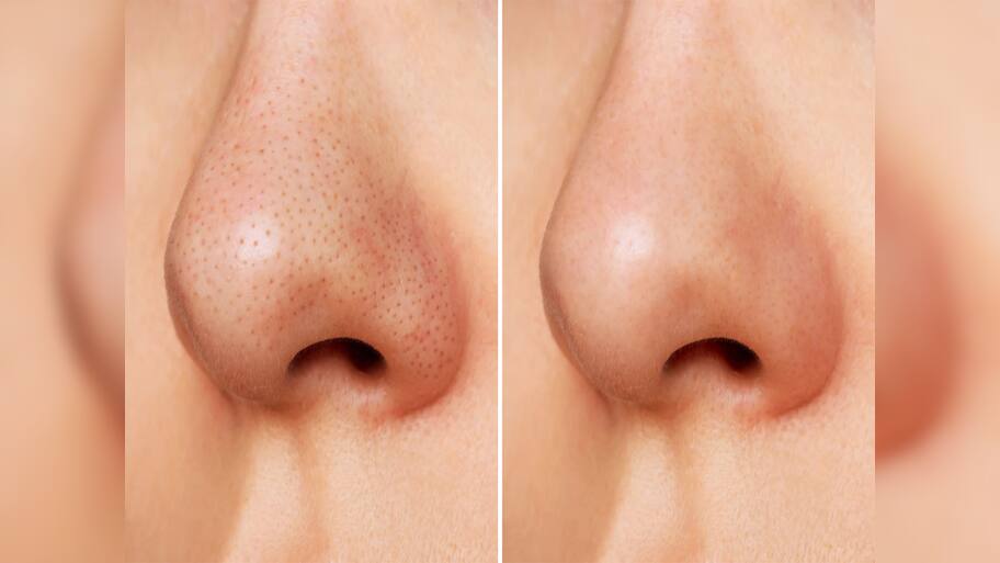 Blackheads: માત્ર 5 મિનિટમાં નાક પરના બ્લેકહેડ્સ થઈ જશે ગાયબ, અપનાવો આ ઘરેલુ ઉપાય