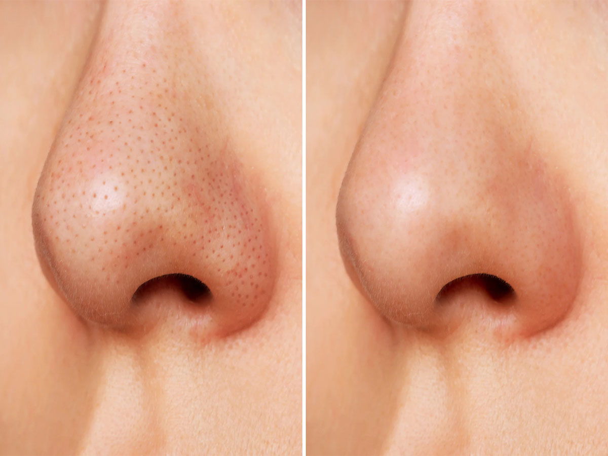 Blackheads: માત્ર 5 મિનિટમાં નાક પરના બ્લેકહેડ્સ થઈ જશે ગાયબ, અપનાવો આ ઘરેલુ ઉપાય Blackheads: માત્ર 5 મિનિટમાં નાક પરના બ્લેકહેડ્સ થઈ જશે ગાયબ, અપનાવો આ ઘરેલુ ઉપાય