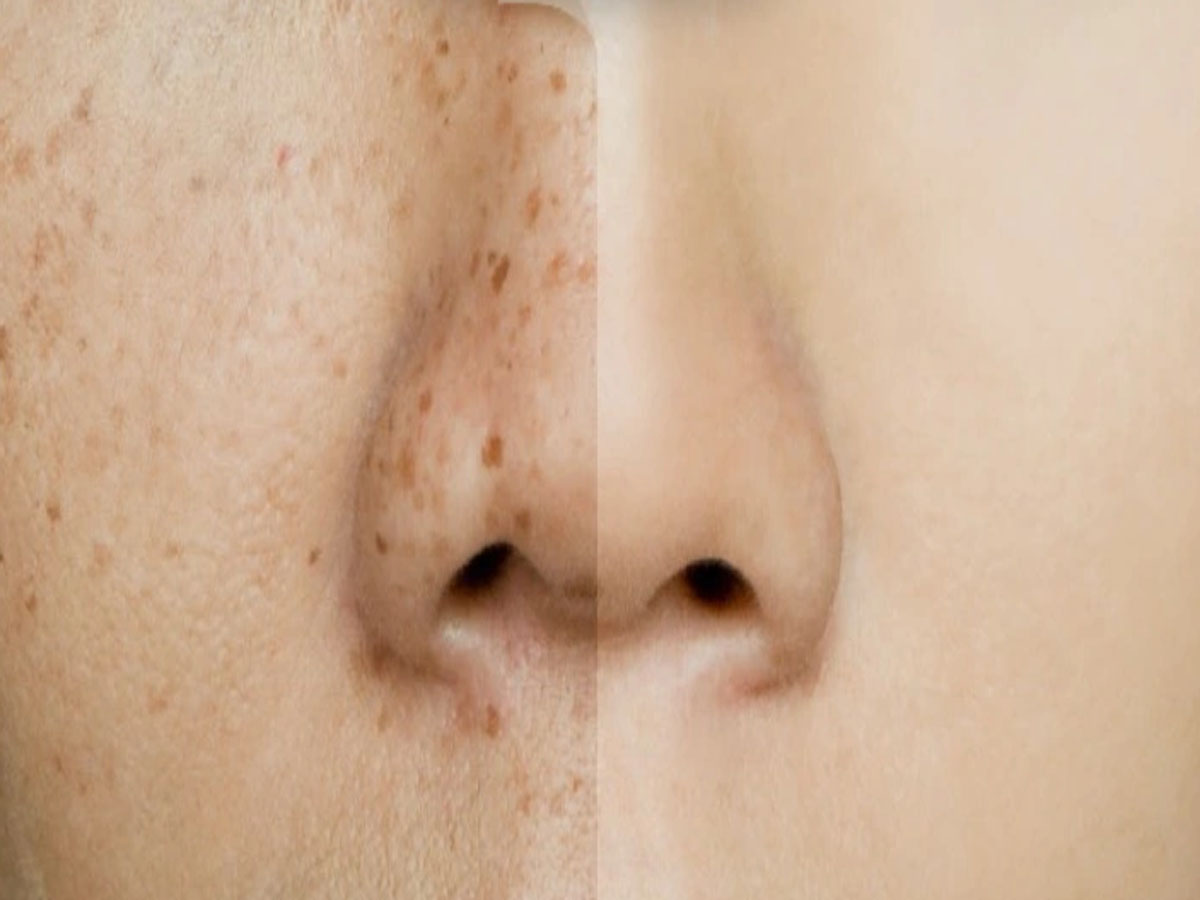 Haldi: ચહેરા પરના જિદ્દી કાળા ડાઘ થઈ જશે દુર, અઠવાડિયામાં 2 વાર હળદર આ રીતે કરો અપ્લાય