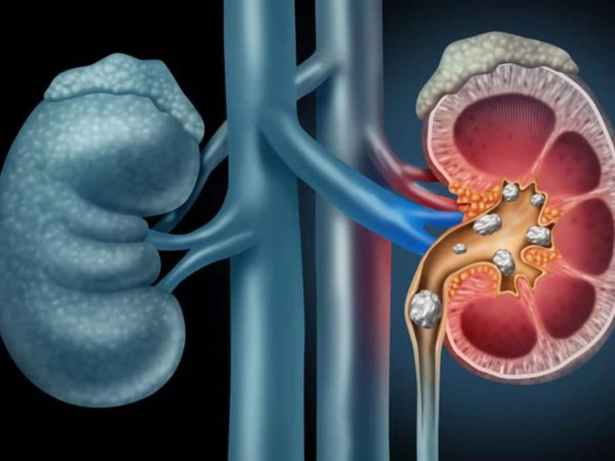 Kidney Stone: આ ભુલના કારણે વારંવાર કિડનીમાં થાય છે પથરી, જાણો કારણ અને બચાવની રીત