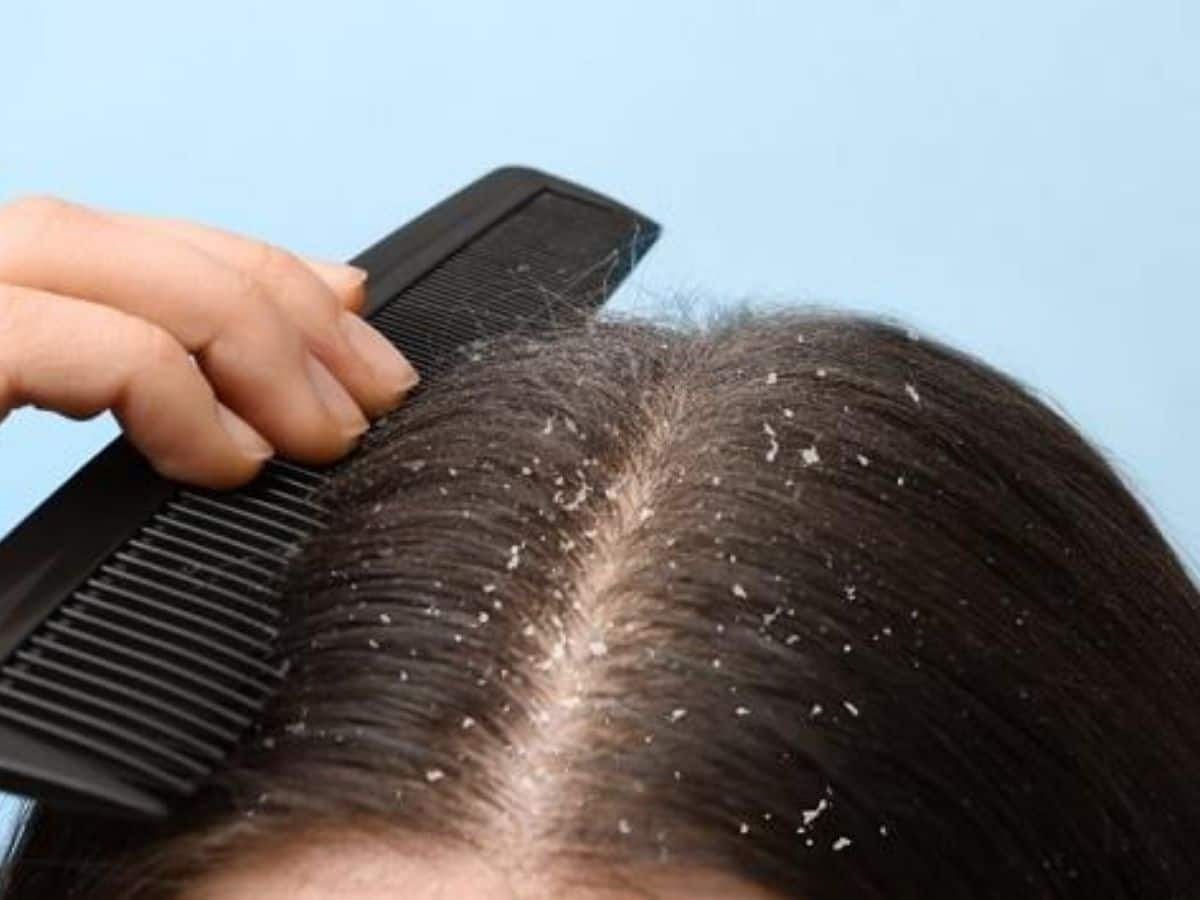 Dandruff solution: શિયાળામાં ડેન્ડ્રફથી છુટકારો મેળવવા માટે 6 અસરકારક ઘરેલું નુસ્ખા