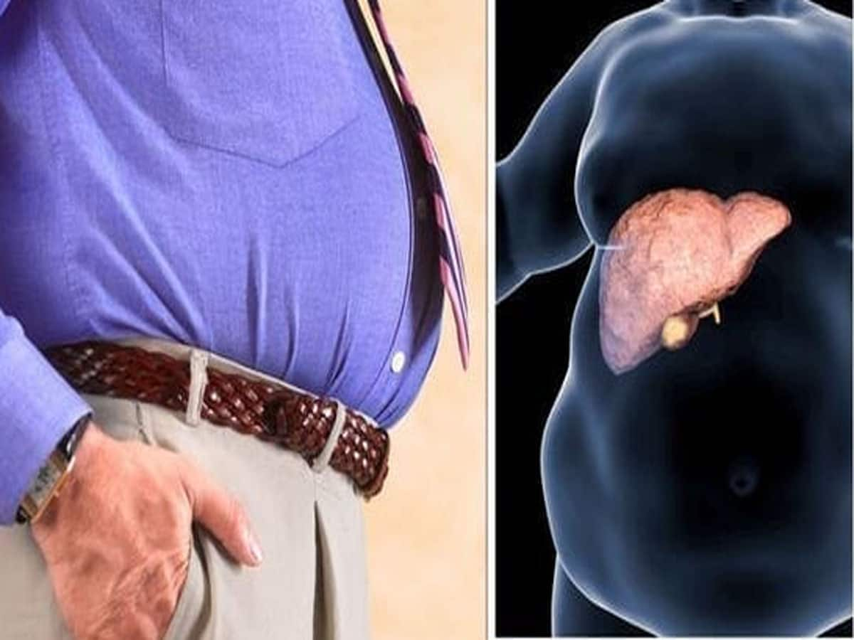 Fatty Liver: પેટની આસપાસ ચરબી વધવાથી વધે છે નોન આલ્કોહોલિક ફેટી લિવરનું જોખમ, જાણી લો બચાવના ઉપાય