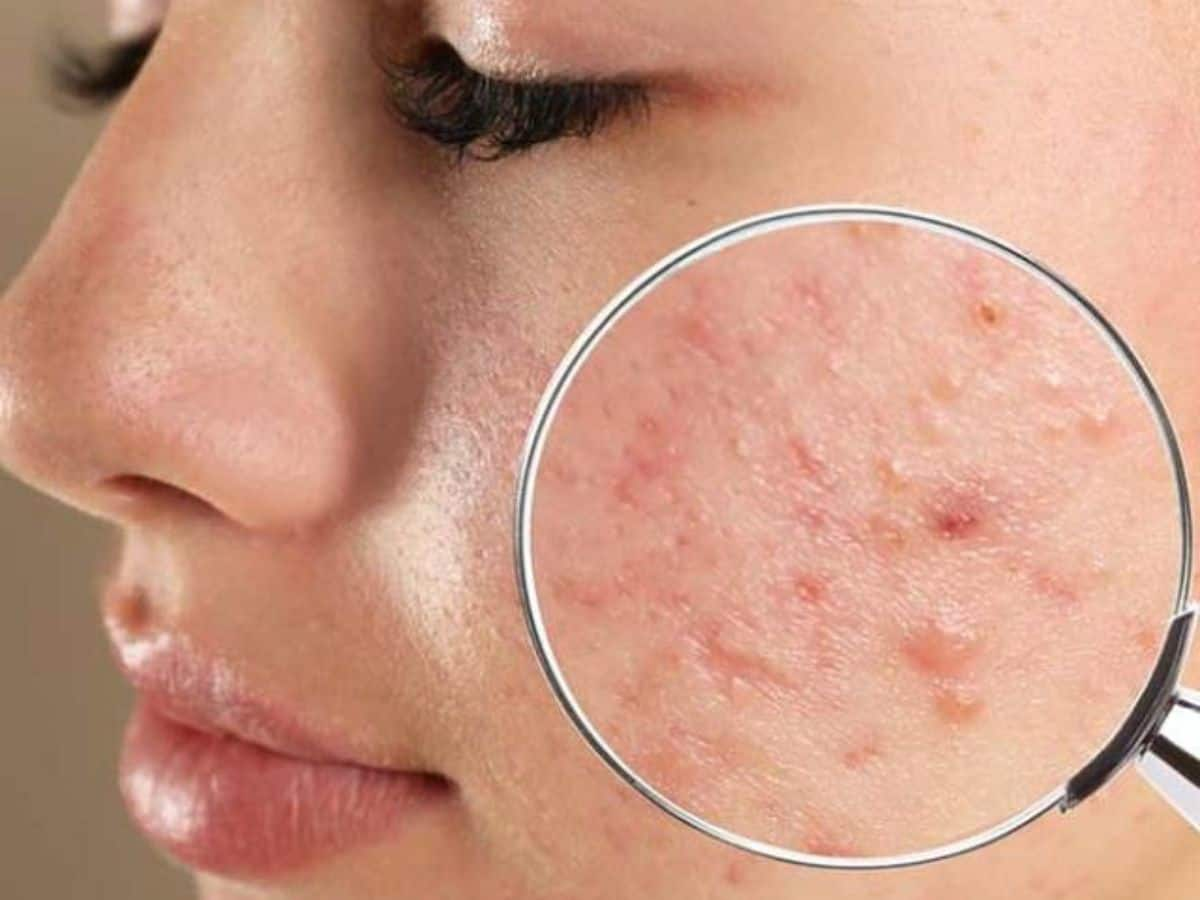 Pimple Clear Skin: ચહેરા પર પિમ્પલ્સ? આ 5 સરળ Tips જે તમારી Skinને બનાવશે બેદાગ!