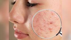 Pimple Clear Skin: ચહેરા પર પિમ્પલ્સ? આ 5 સરળ Tips જે તમારી Skinને બનાવશે બેદાગ!