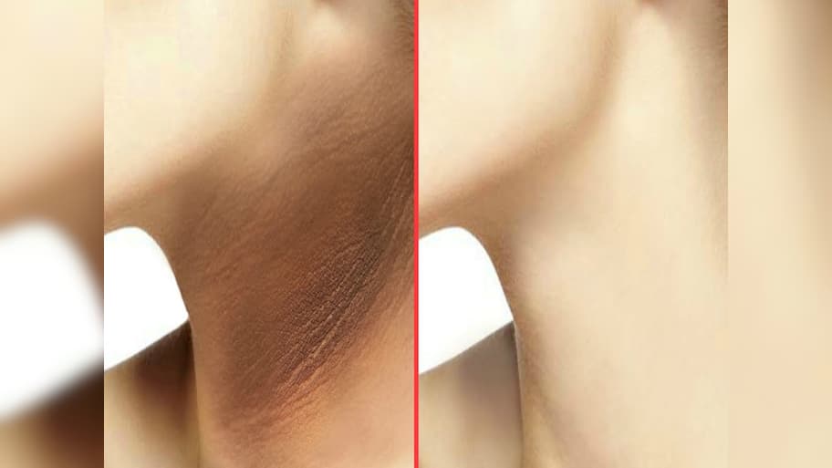Dark Neck: ગરદનની સ્કિન ચહેરા કરતાં કાળી છે? કોફીમાં આ 2 વસ્તુ મિક્સ કરી લગાડો, ગરદનની કાળી ત્વચા ચહેરા જેવી ગોરી થશે