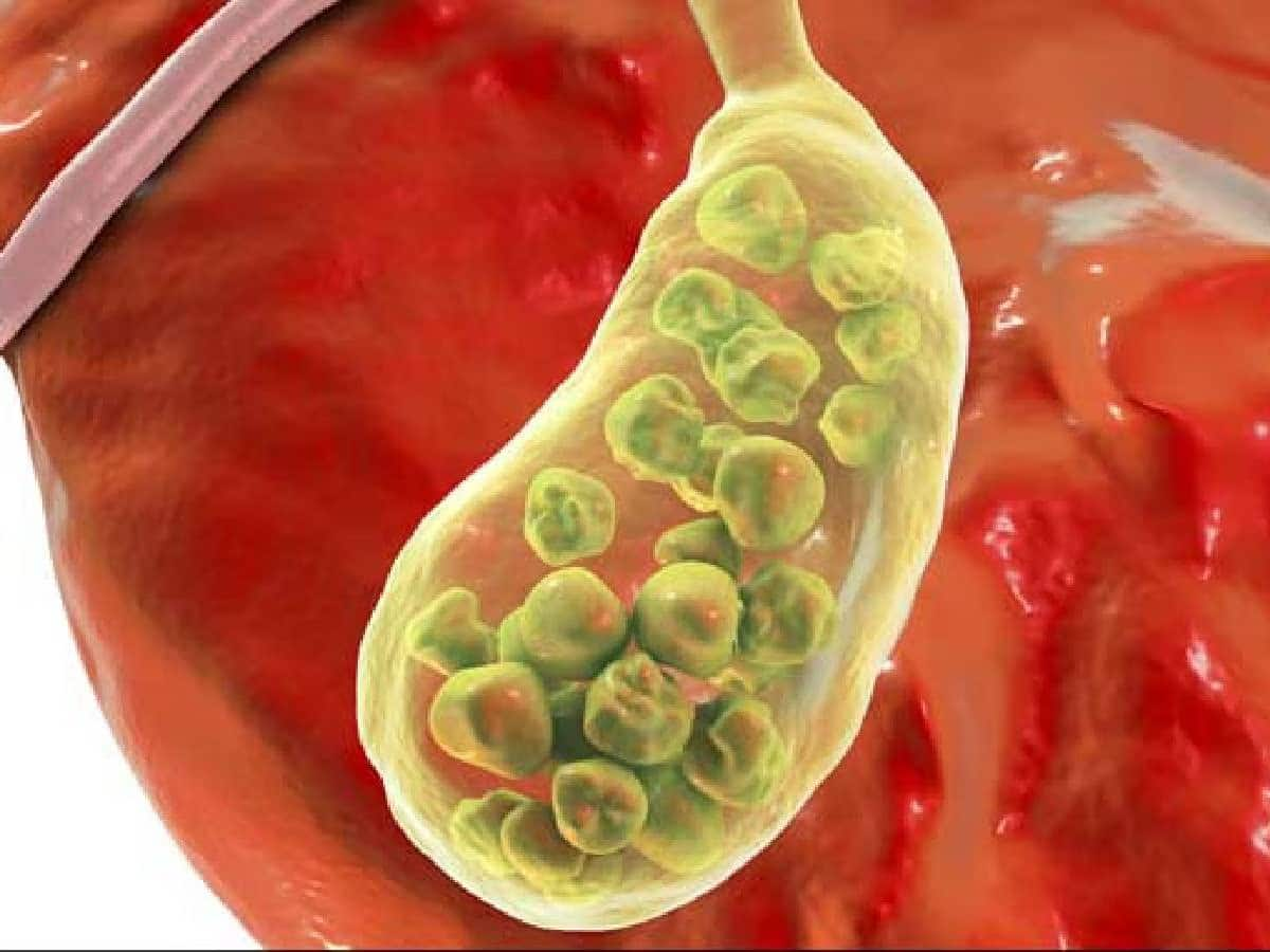 Gallbladder Stone: પેટમાં ગયાની સાથે પથરી બની જાય આ 4 વસ્તુઓ, પછી માત્ર ઓપરેશન જ ઈલાજ, ખાતા પહેલા 1000 વાર વિચારજો