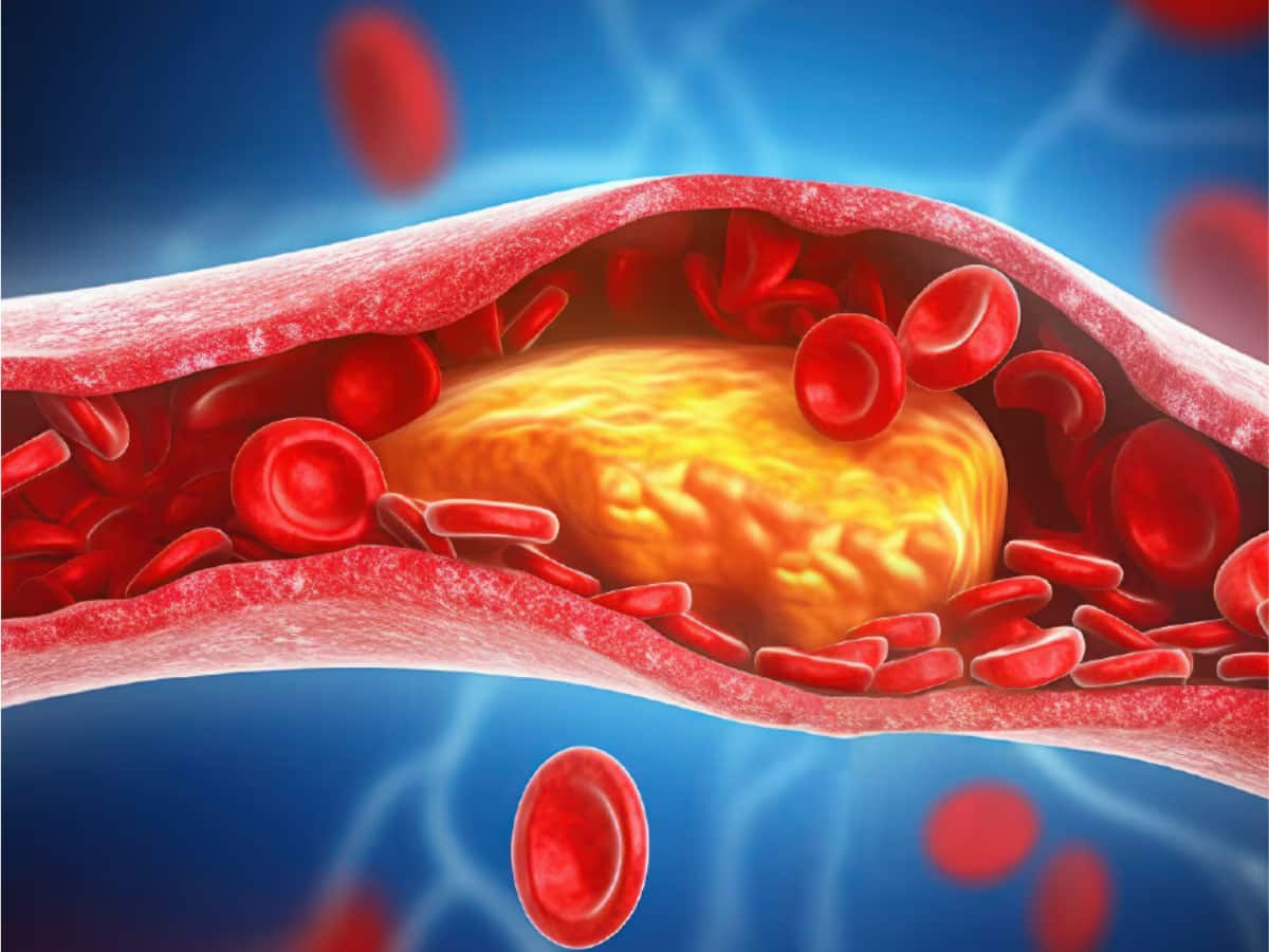 LDL Cholesterol: દવા વિના નસોમાં વધતું બેડ કોલેસ્ટ્રોલ દુર થઈ શકે છે, લક્ષણ દેખાય કે તુરંત આ જ્યુસ પીવાનું શરુ કરો