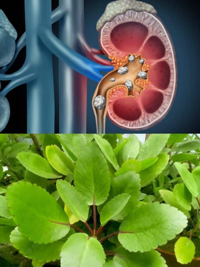 How To Use Patharchatta For Kidney Stone Kidney Stone causes | how to use Patharchatta leaf in kidey stone