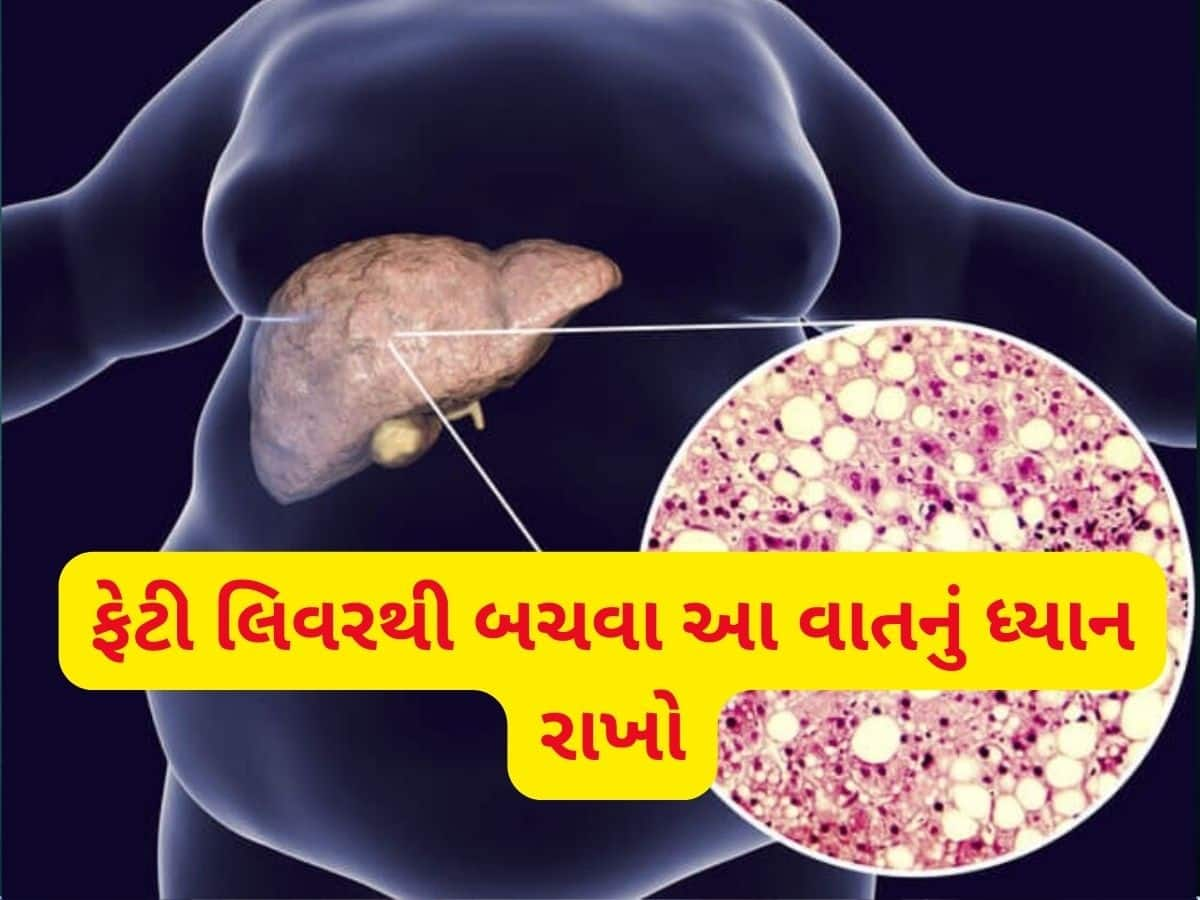 આ 5 પ્રકારના ફૂડ્સ વધારે છે ફેટી લિવરનો ખતરો, દરરોજ સેવન કરશો તો ભારે પડશે