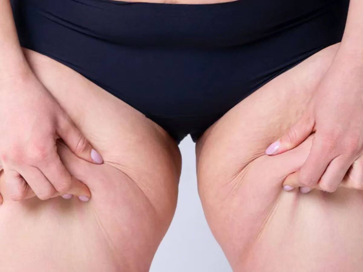 Lower Body Fat: કમર નીચેના અંગો પર વધતી ચરબી આ બીમારીનું લક્ષણ હોય શકે છે, જાણી લો આ બીમારી વિશે ફટાફટ