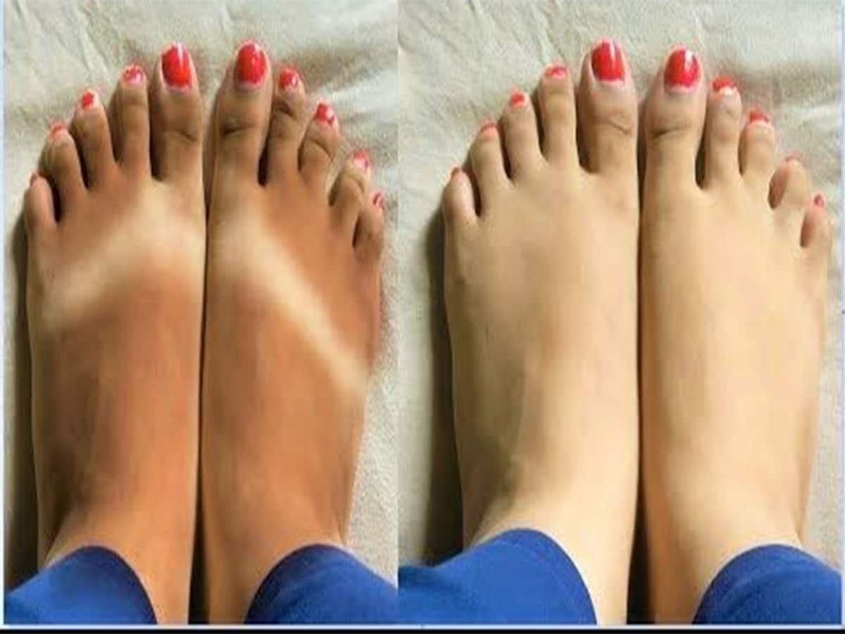 Tanning: એકવારમાં દુર થશે તડકાના કારણે હાથ-પગ પર થયેલું ટેનિંગ, આ 5 વસ્તુથી ફટાફટ નોર્મલ થઈ જાય છે સ્કિન 